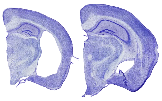 Two purple-stained slices of mouse brain are positioned side-by-side. The one on the left has a huge gap in it, a sign of Alzheimer's-like damage.