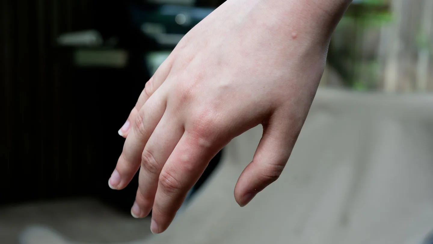 The back of a hand inflamed with multiple mosquito bites