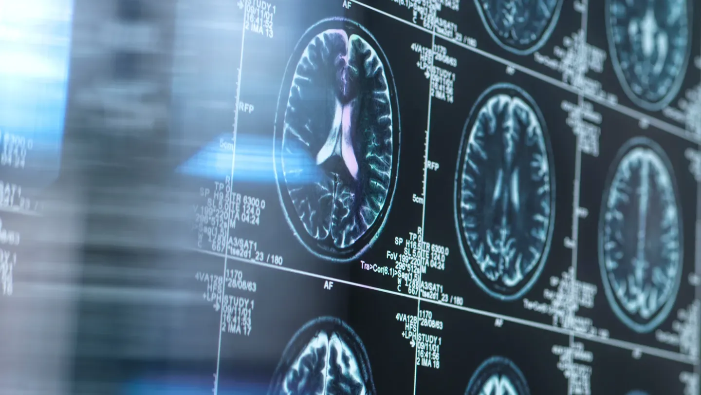 Image of MRI scans